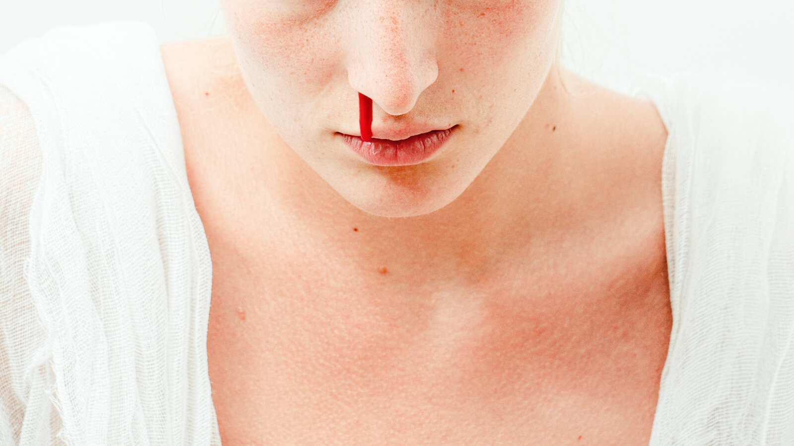 Những cấp độ của sốt xuất huyết và dấu hiệu bệnh 2