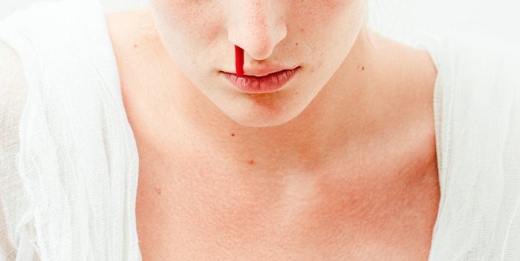 Những cấp độ của sốt xuất huyết và dấu hiệu bệnh