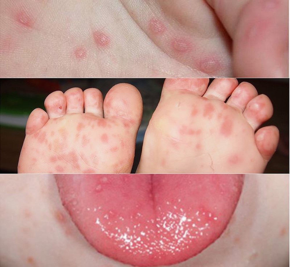 Tăng cường, phòng chống dịch bệnh tay chân miệng 1