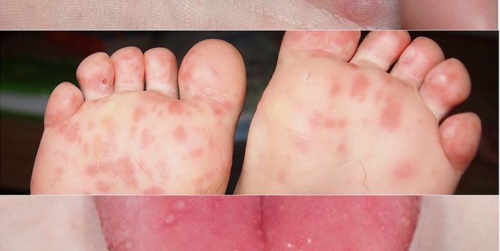 Tăng cường, phòng chống dịch bệnh tay chân miệng