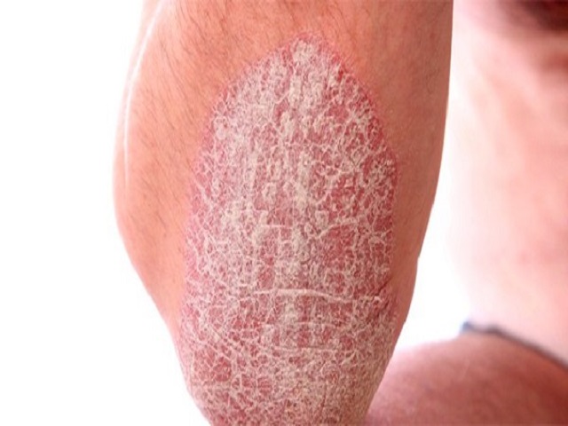 Bệnh vảy nến gây ra những vảy óng bạc, khô và nhô lên bề mặt da