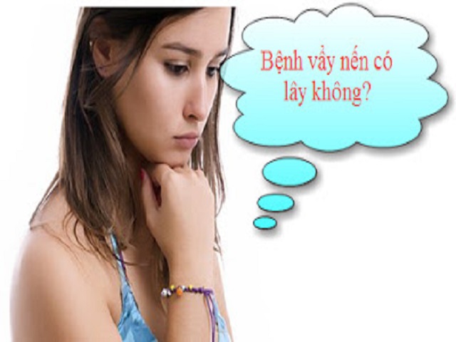  Bệnh vảy nến có lây không