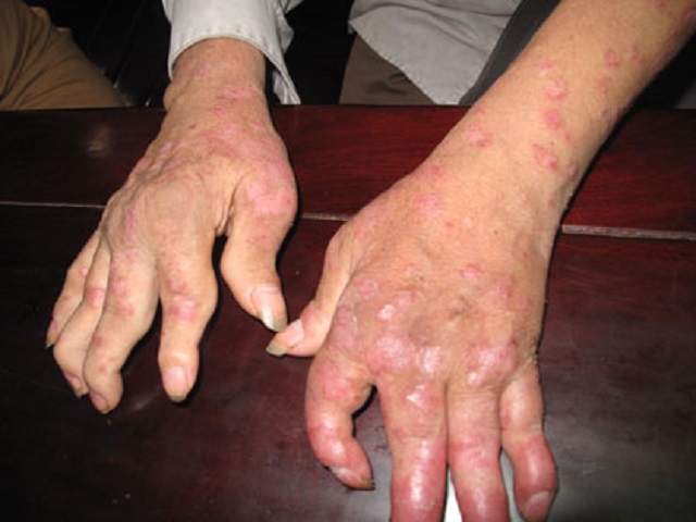 Bệnh vảy nến thể khớp