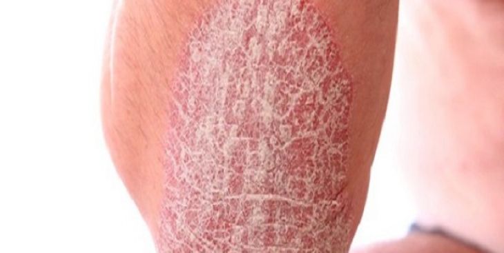 Giải đáp thắc mắc bệnh vảy nến có lây không?