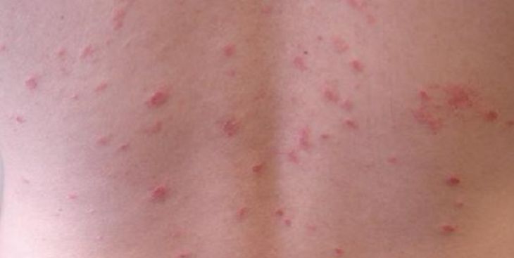 Hình ảnh bệnh vảy nến ở các mức độ khác nhau