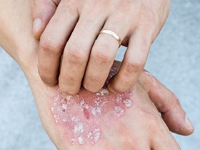 Bệnh vảy nến gây nên tình trạng ngứa ngáy, khó chịu cho bệnh nhân