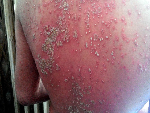 Bệnh vảy nến thể mủ gây nguy hiểm nghiêm trọng và hiếm gặp