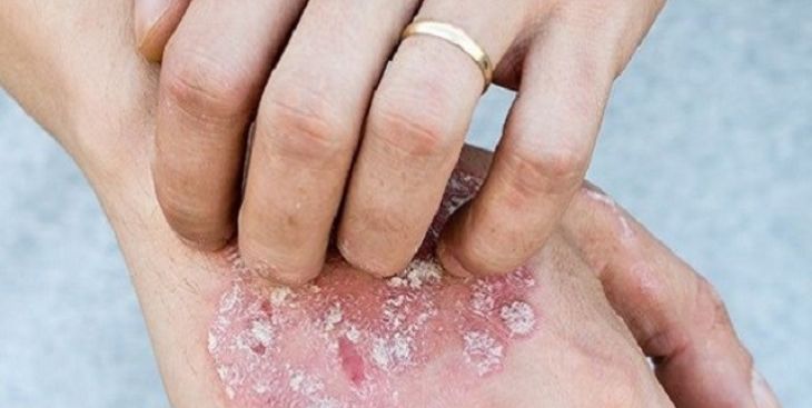 Bệnh vảy nến có ngứa không? Cách phòng tránh bệnh như thế nào?