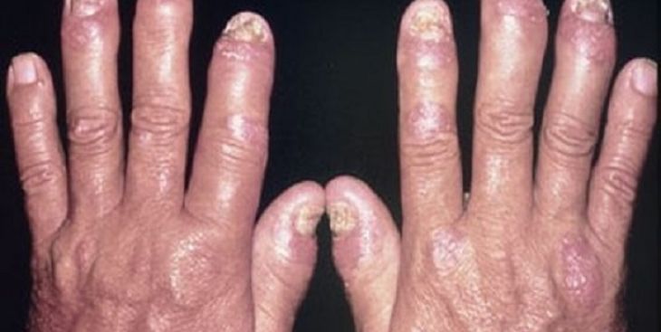 Cách nhận biết các dạng thể vảy nến