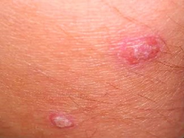 Vảy nến thể giọt trông giống như bệnh giang mai ở mức độ 2