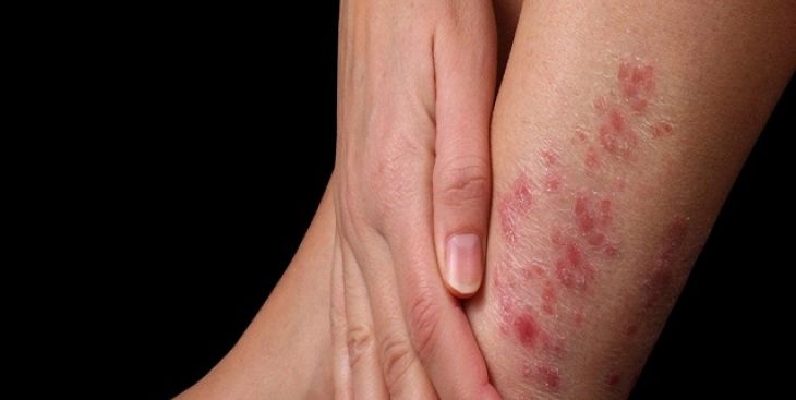 Á vảy nến và những điều cần biết về căn bệnh này