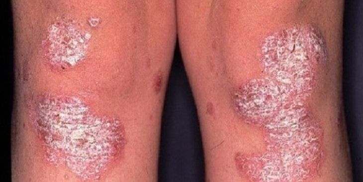 Viêm khớp vảy nến và những thông tin cơ bản bạn cần biết