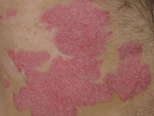 Bệnh vảy nến gây tổn thương da