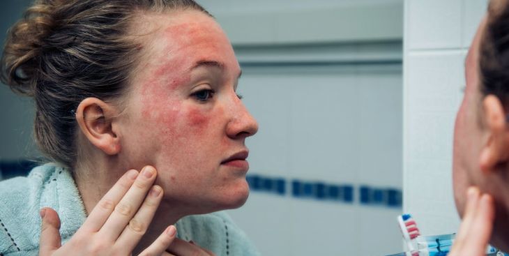 Một số thông tin cần biết khi bị vảy nến