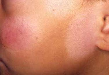  Bệnh vảy phấn trắng không lây qua đường tiếp xúc