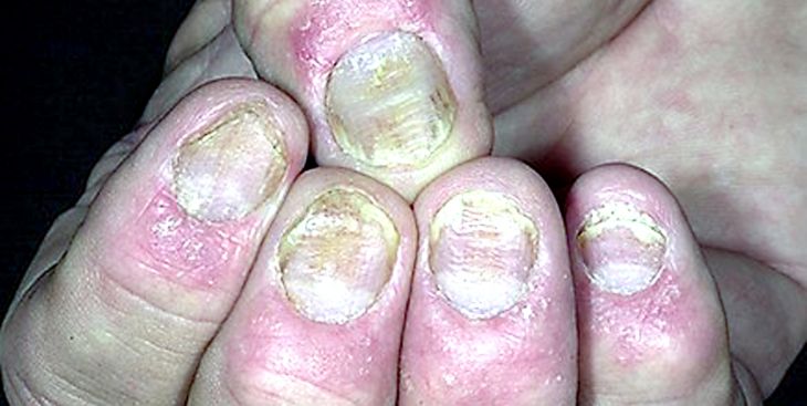 Tìm hiểu thông tin liên quan đến vảy nến móng tay