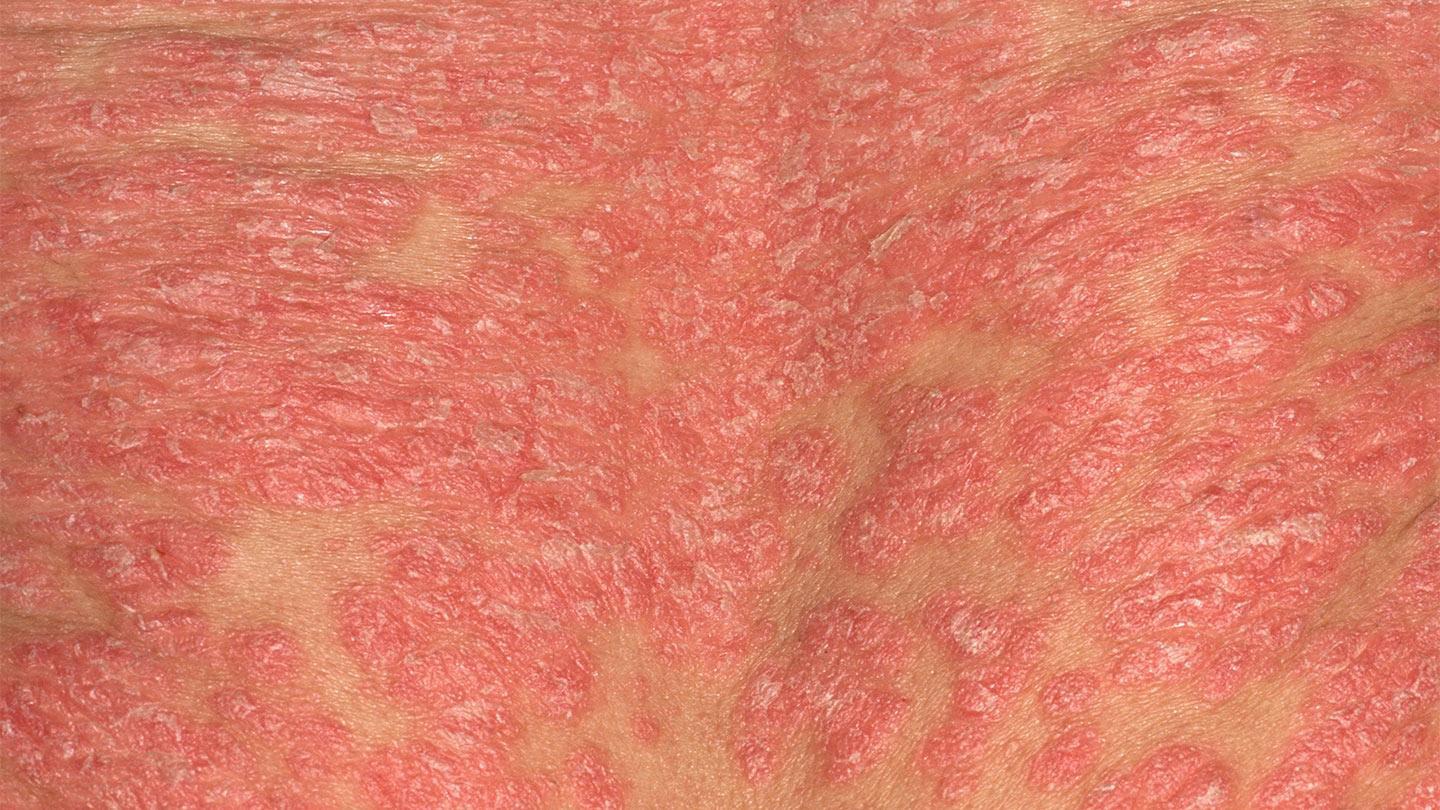 Bệnh vảy nến toàn thân