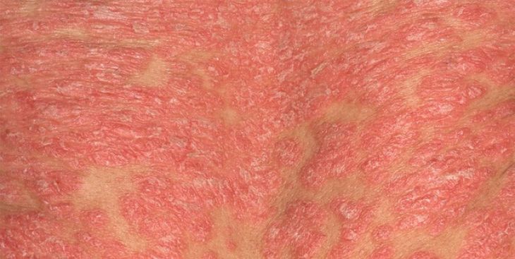 Những thông tin cần biết về bệnh vảy nến mủ