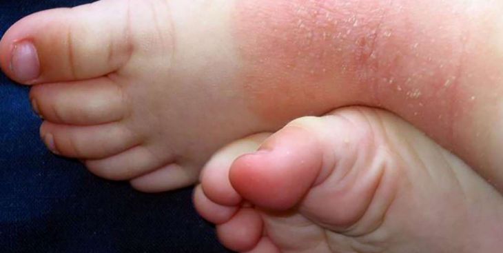 Tìm hiểu về bệnh vảy nến ở chân và dấu hiệu nhận biết