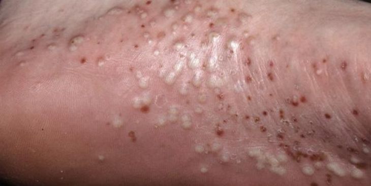 Những cách chữa bệnh vảy nến tại nhà hiệu quả