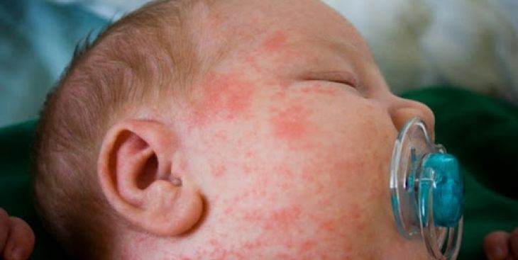 Tìm hiểu về bệnh vảy nến ở trẻ em