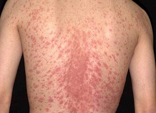 Vảy nến ở lưng