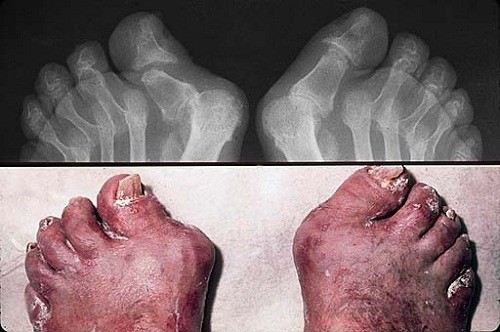 Vảy nến khớp chân