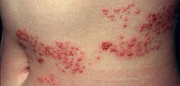 Vảy nến thể mủ