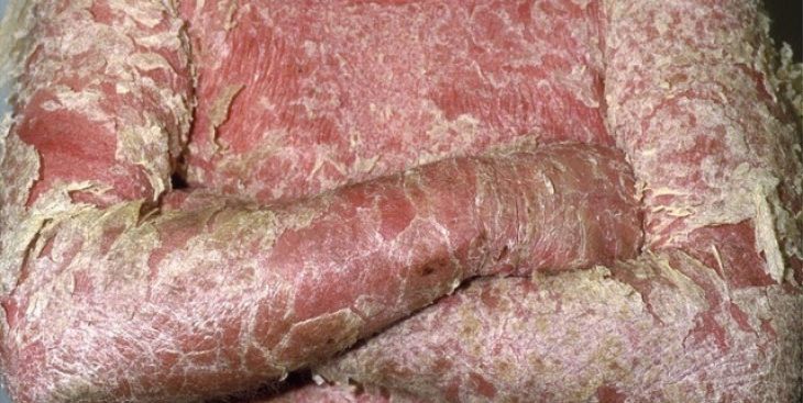 Vì sao nói “bị vảy nến khổ cả đời”?