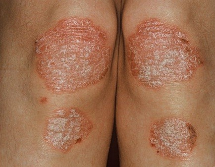 Bệnh vảy nến gây ảnh hưởng đến thẩm mỹ